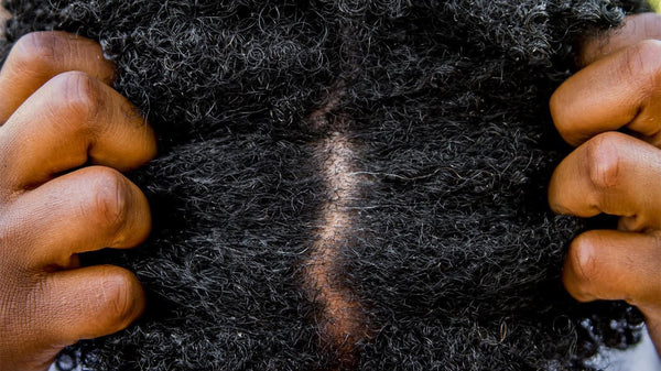 Hair Scalp